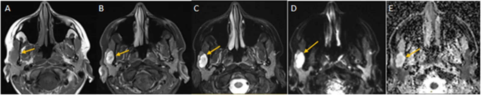 A-E. 26-year-old female with right pleomorphic adenoma, demonstrating typical imaging features. A Axial T1WI shows a well-defined lobulated tumour in the superficial lobe of the right parotid gland that is hypointense to the parotid gland (arrow). B Post contrast T1WI shows marked heterogenous enhancement (arrow). C T2WI shows predominant marked hyperintense signal intensity compared to the parotid gland and a well-encapsulated tumour (arrow). D DWI and E ADC maps show a lesion with high ADC values (arrows)