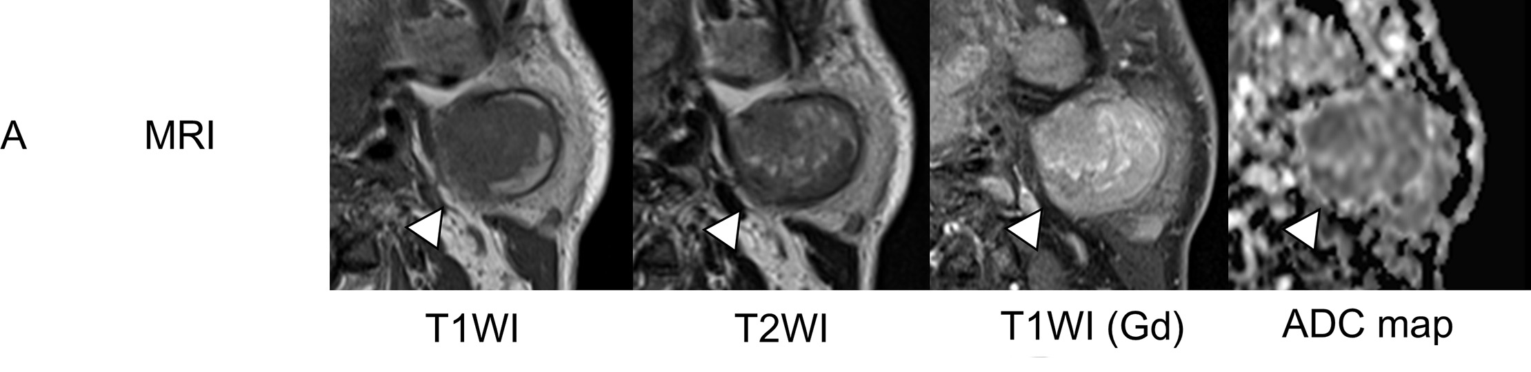 Warthin tumor on the left side of a 60-year-old man (case 14). (A) Axial MRI (white arrowheads) showed heterogenous (low to high) intensity on T1WI, heterogenous (low to intermediate) intensity on T2WI, strong gadolinium enhancement, and a low signal on the ADC map (ADCmean 0.94 × 10−3 mm2/sec).